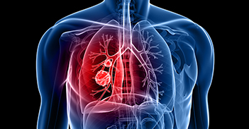 上海肺癌筛查，哪些手段可以诊断肺癌