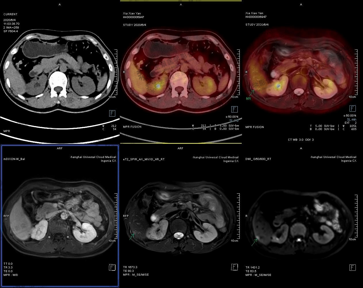 肝脏疾病-16- 64 原发性肝癌破裂出血（解剖号：A3401）