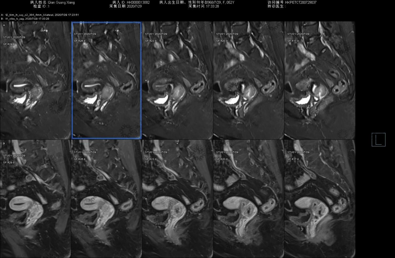 病例21-2017：一名患宫颈内癌的28岁孕妇 - NEJM医学前沿