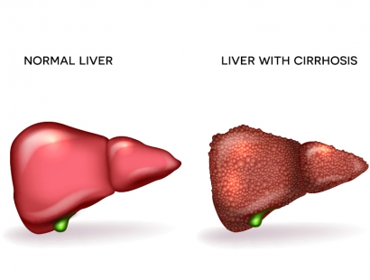 肝脏血管瘤和肝癌的区别