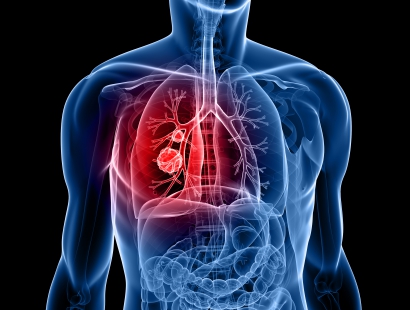 肺癌的早期筛查方法以及高危人群