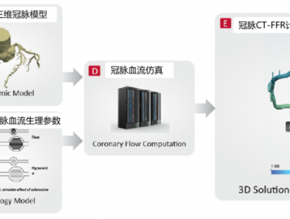 冠脉检查新技术-CT-FFR