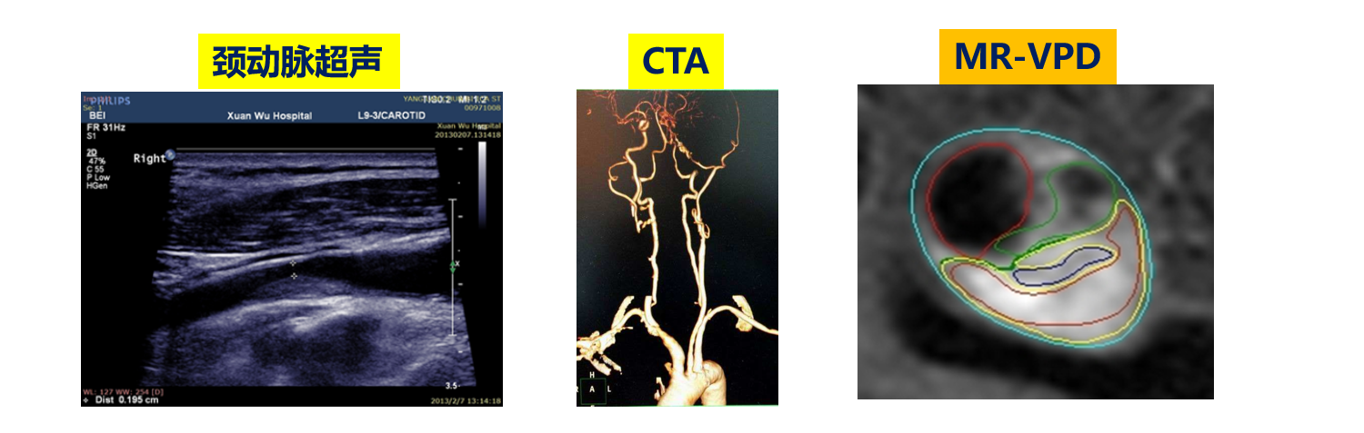 斑块不可怕！全景MR-VPD检查，诊断斑块危险性