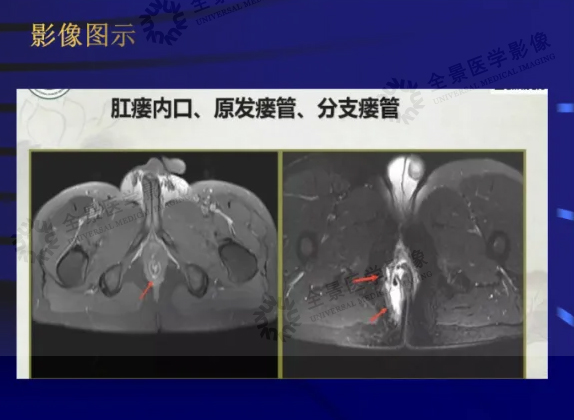 4+水印