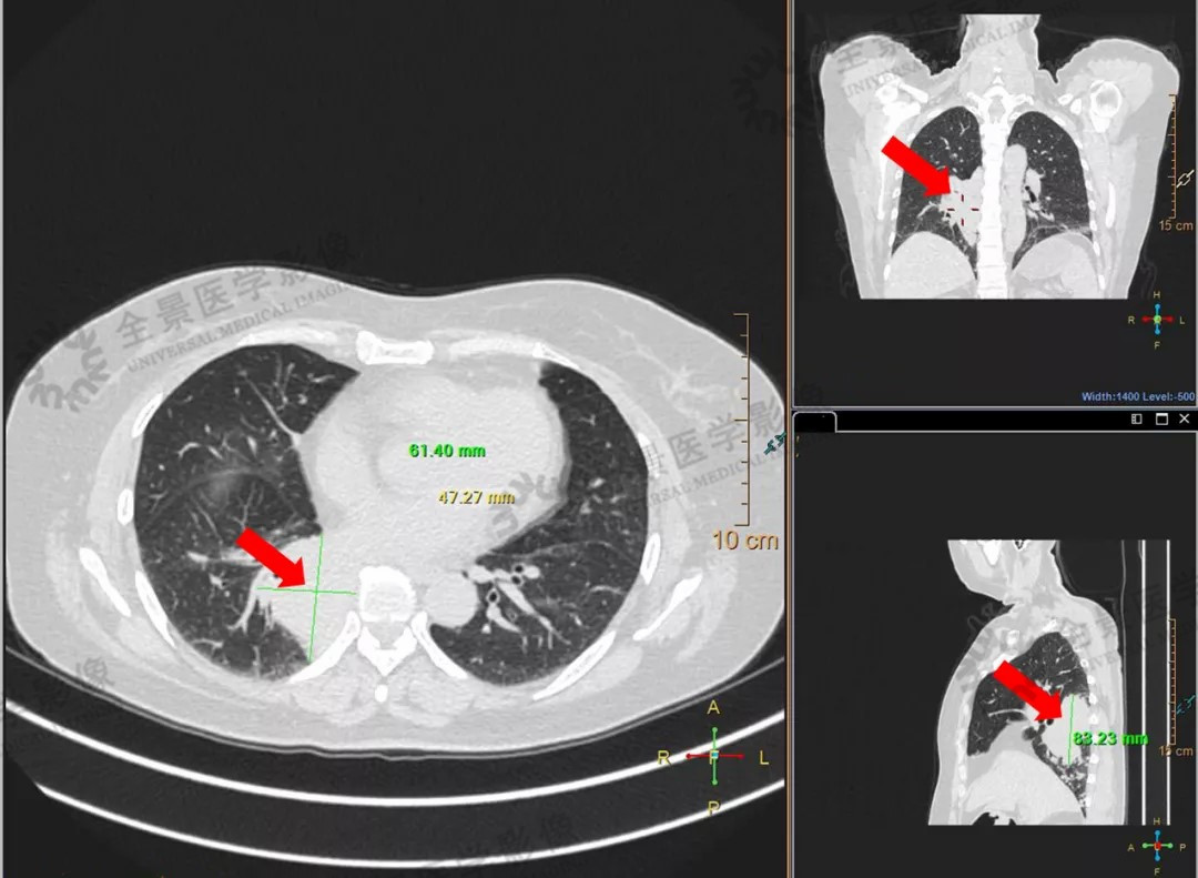 度伐利尤在美获批广泛期小细胞肺癌一线治疗，史上最长生存期方案 - 哔哩哔哩